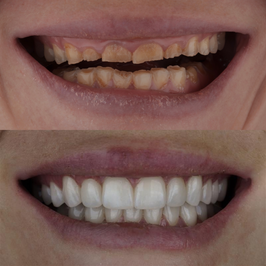 Before and after full mouth rehabilitation with crowns